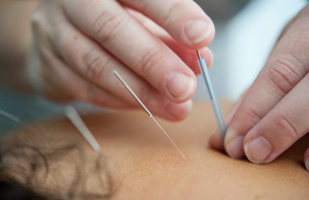 Image of an acupuncturist  in the Chicago area using the needles on a woman's back. Have you been interested in holistic acupuncture in Orland Park, IL 60464? Anchored in Health can provide you relief from the pain with acupuncture in Orland Park, IL 60468. Contact us today to book an appointment.