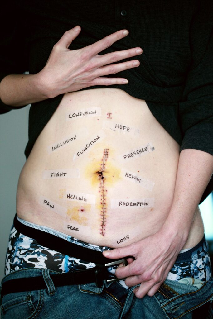 Image of an abdomen with a scar and words written on it. What is chronic disease? If you think you have one functional medicine in Orland Park, IL can help!. With the help of a holistic doctor you can start feeling better. Learn ways to deal with your chronic disease from a functional medicine doctor in the Chicago area today.