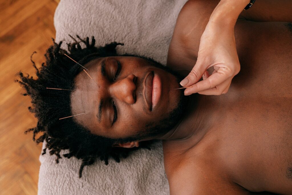 A close up of a man with acupuncture needles in his face while laying down. Learn how an acupuncturist in the Chicago area can offer support by searching for acupuncture in Orland Park, IL. Search for holistic acupuncture Orland Park, IL today to learn more. 
