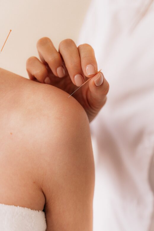 A close-up of a doctor putting an acupuncture needle into a person’s shoulder. Learn how acupuncture in Orland Park, IL can offer support by contacting an acupuncturist in Orland Park, IL or search for “holistic acupuncture Orland Park, IL”.