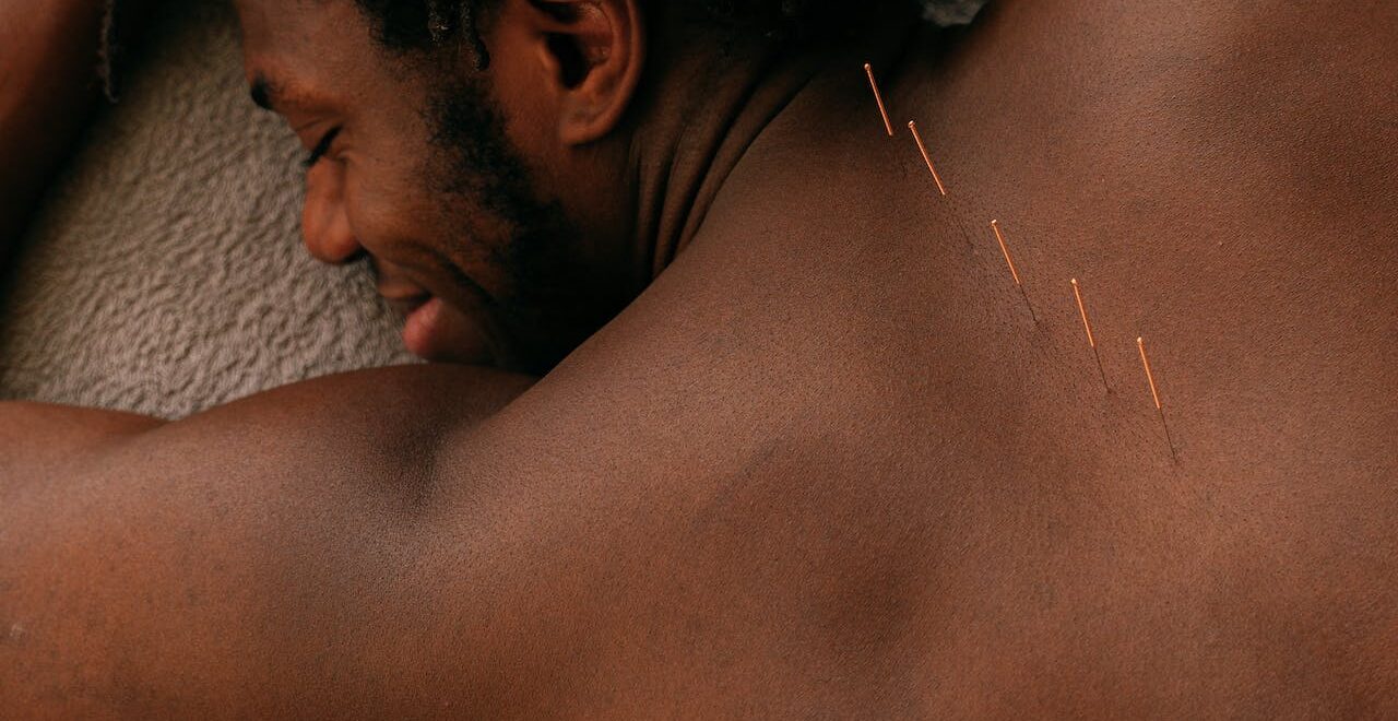 A man smiles with acupuncture needles in their back. Learn how acupuncture can work with chiropractic care in Orland Park, IL. Search for an acupuncturist in Orland Park, IL or search for chiropractic care for sciatica in Orland Park, IL.