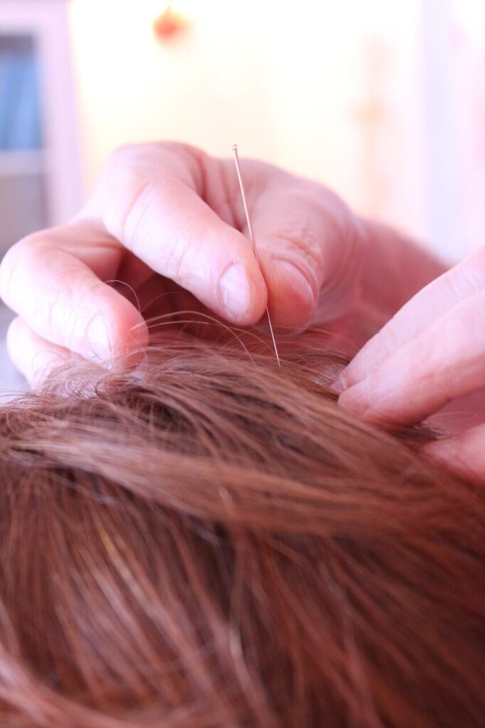 A close up of a acupuncture needle being placed in a persons scalp. This could represent the process of acupuncture in Orland Park, IL that an acupuncturist in the Chicago area can offer. Search for holistic acupuncture Orland Park, IL to learn more about the benefits of holistic medicine in the Chicago area today.
