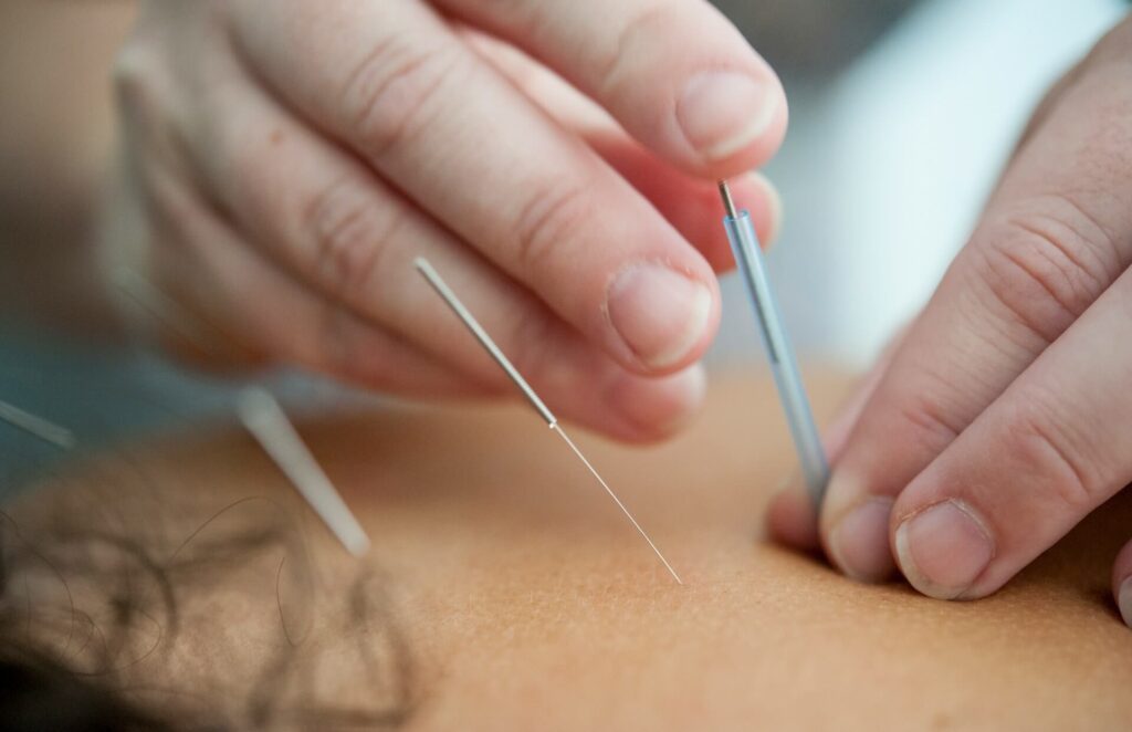 A close up of a hand placing acupuncture needles in the upper back of a person. This could represent the benefits of acupuncture in Orland Park, IL. Learn more about the support an acupuncturist in the chicago area can offer in addressing chronic pain, mental health concerns, and more. Search for holistic acupuncture orland park, il to learn more.
