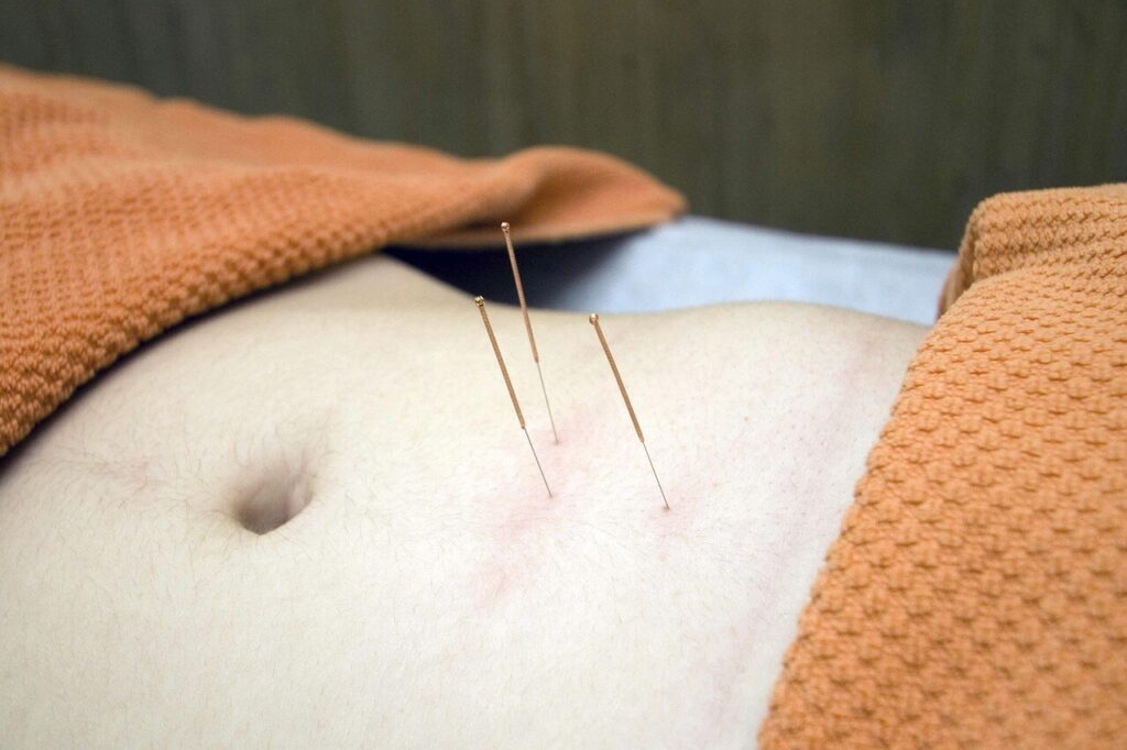 Shows pins in someone's stomach. Represents how acupuncture in orland park, il with a functional medicine doctor in the chicago area can empower you and support your body.