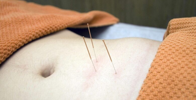 Shows a person covered in towels with acupuncture needles in their stomach. Represents how an acupuncturist in the chicago area and functional medicine in orland park, il can help you on your weight loss journey.