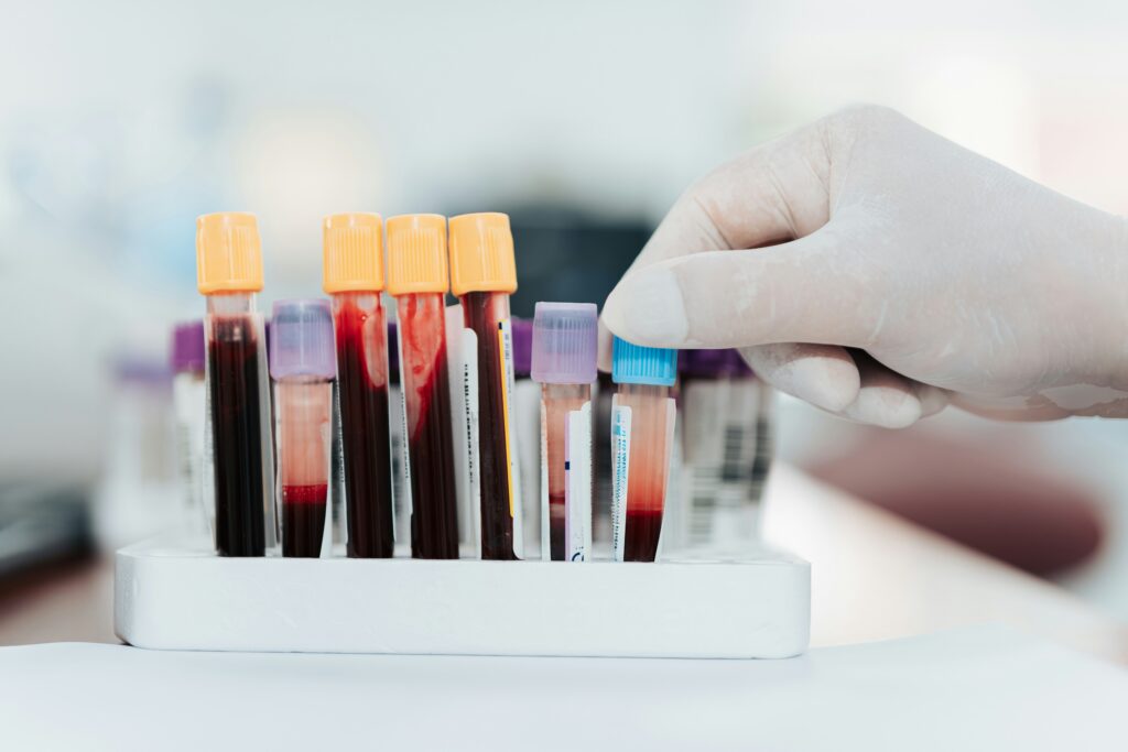 A gloved hand testing blood samples  for functional medicine analysis. 